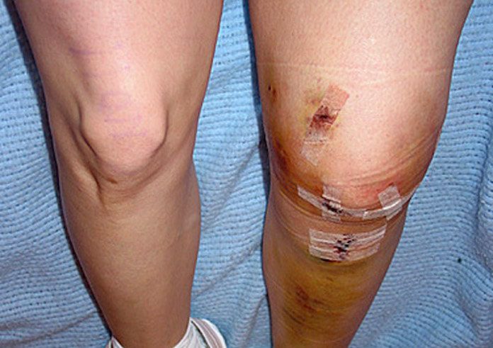 Read more about the article Anterior Cruciate Ligament Surgeries on the Rise in Teenage Girls